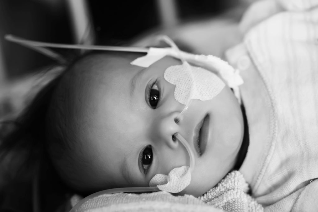 Baby with Down syndrome and breathing tubes.