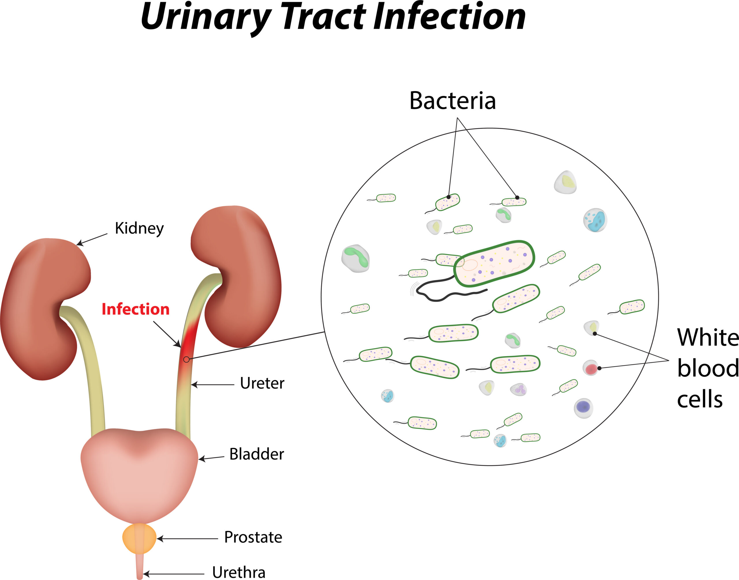 Diagram depicting an infection of the urinary tract. 