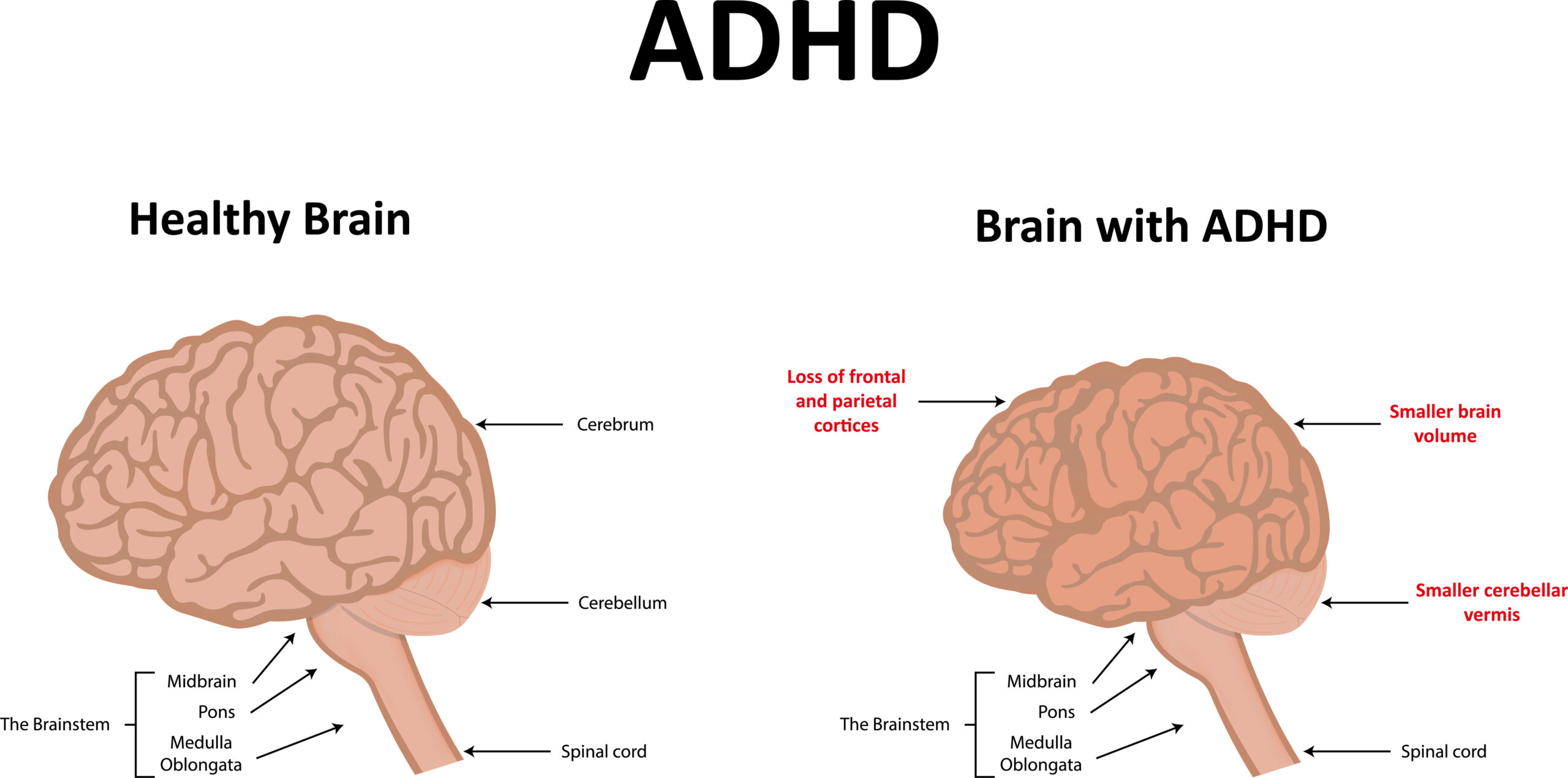 Illustration showing the differences between a healthy brain and a brain with ADHD.