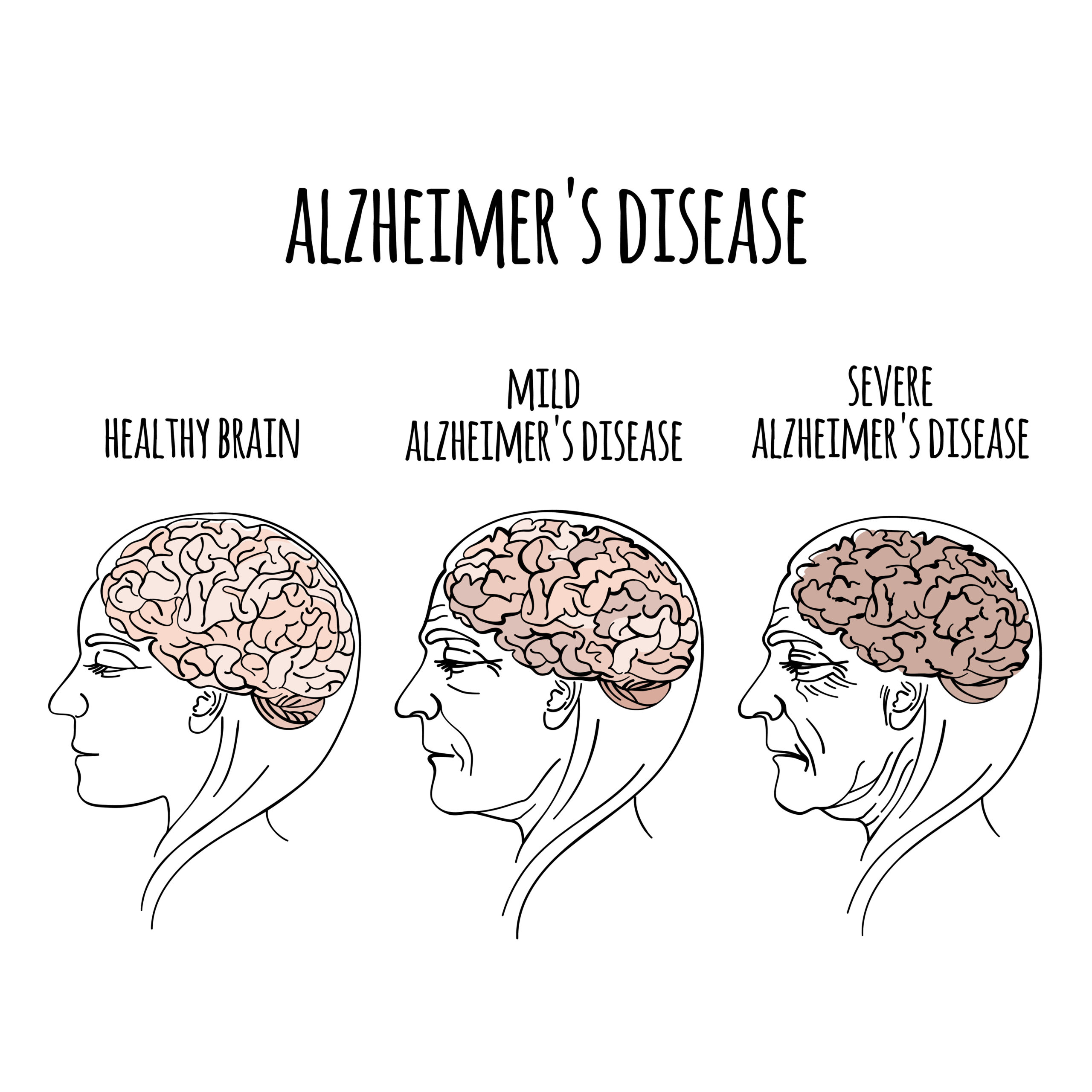 Illustration of a healthy brain, a brain with mild Alzheimer's and a brain with severe Alzheimer's