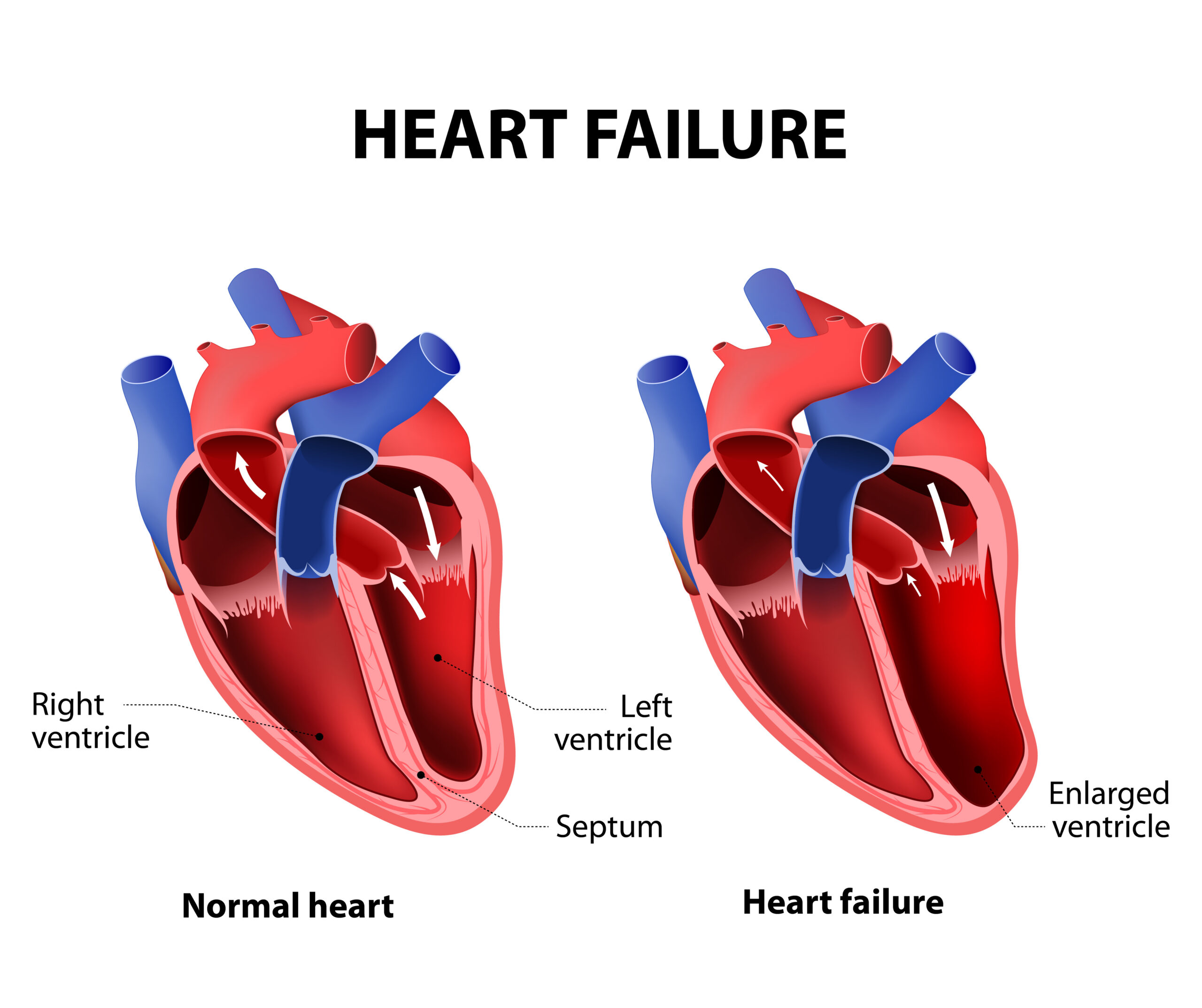 Diagram depicting the ventricles of a healthy heart versus a heart that has failed.
