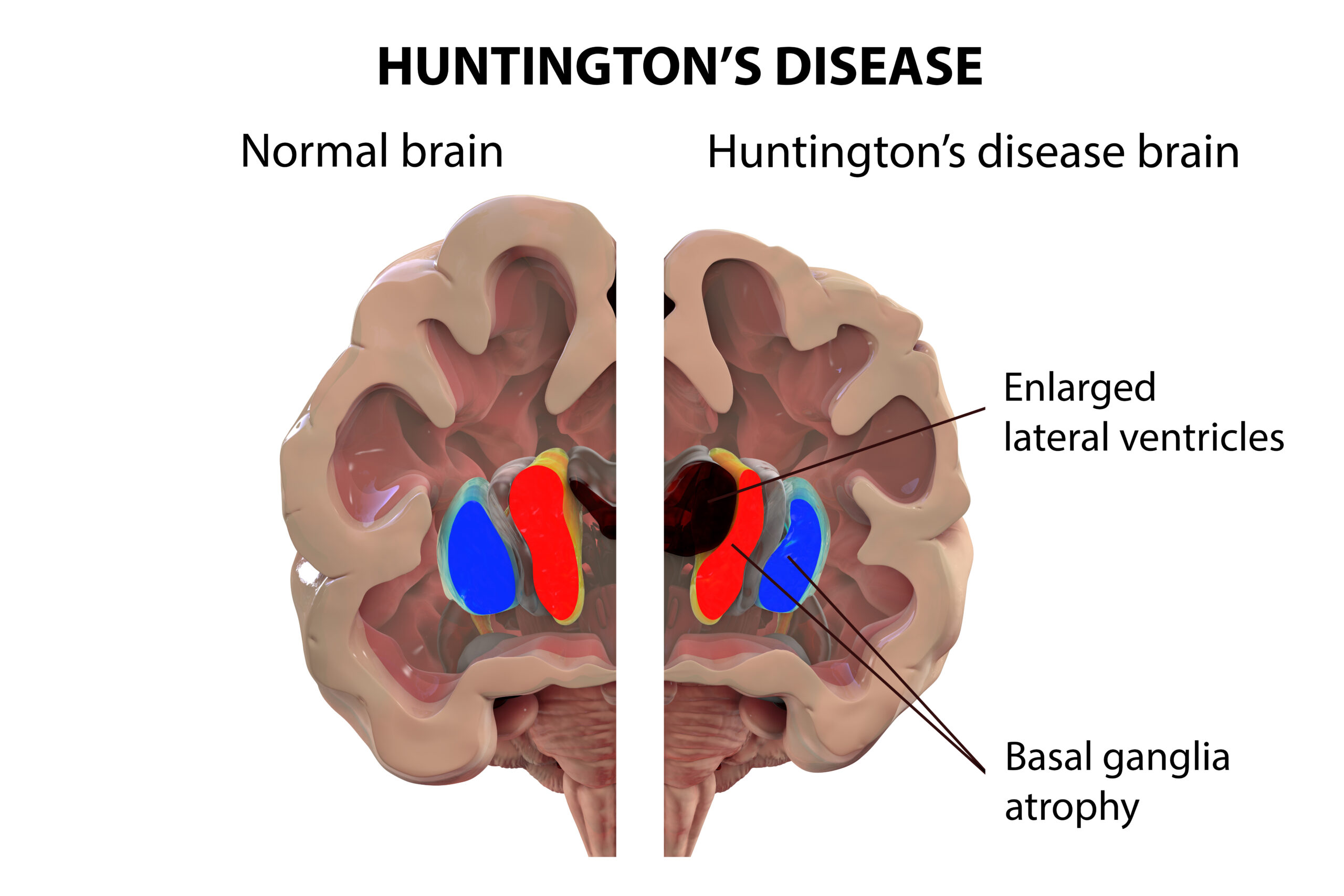 Illustration comparing normal brain to brain with Huntington's disease. 