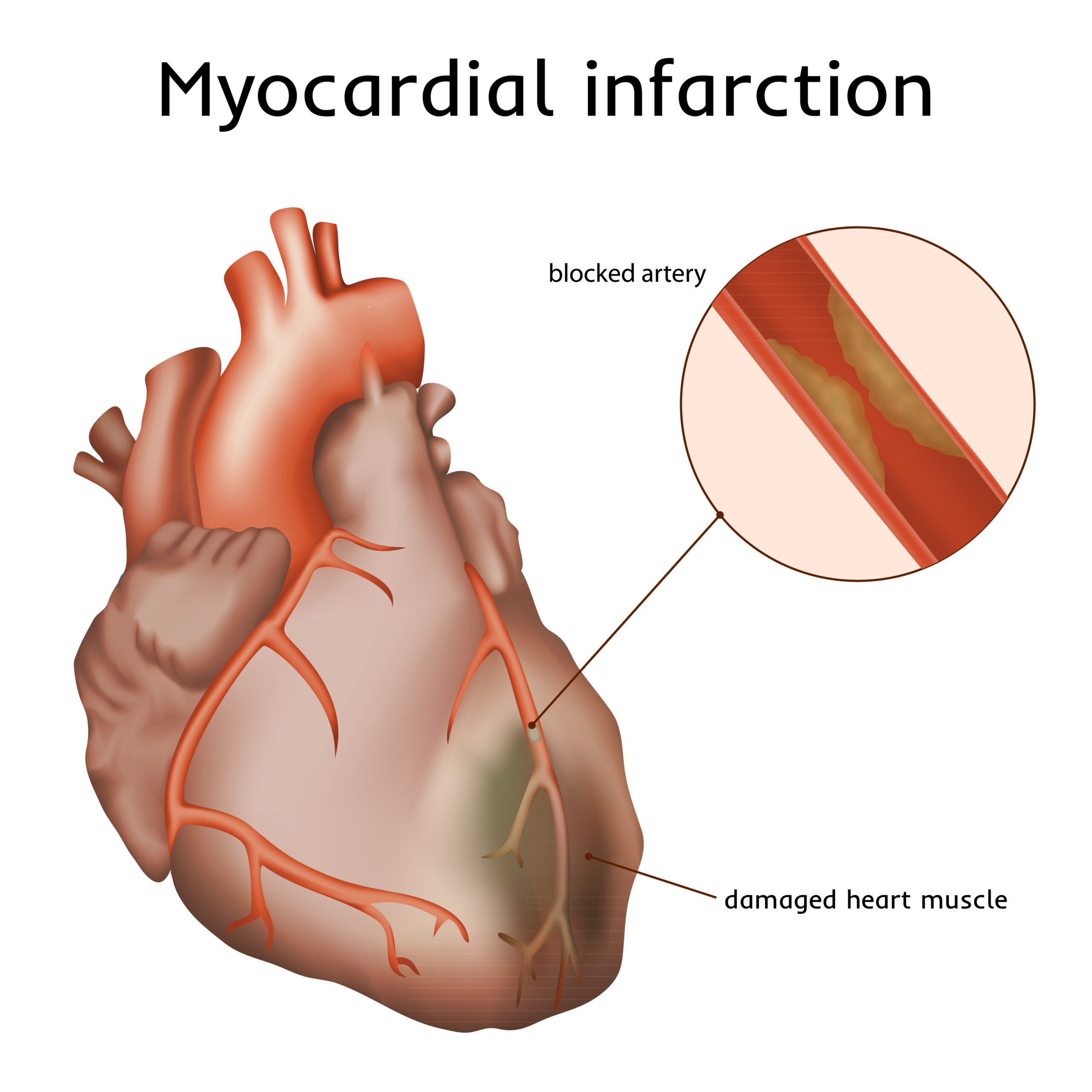 Diagram illustrating a blocked artery and a damaged muscle of the heart.