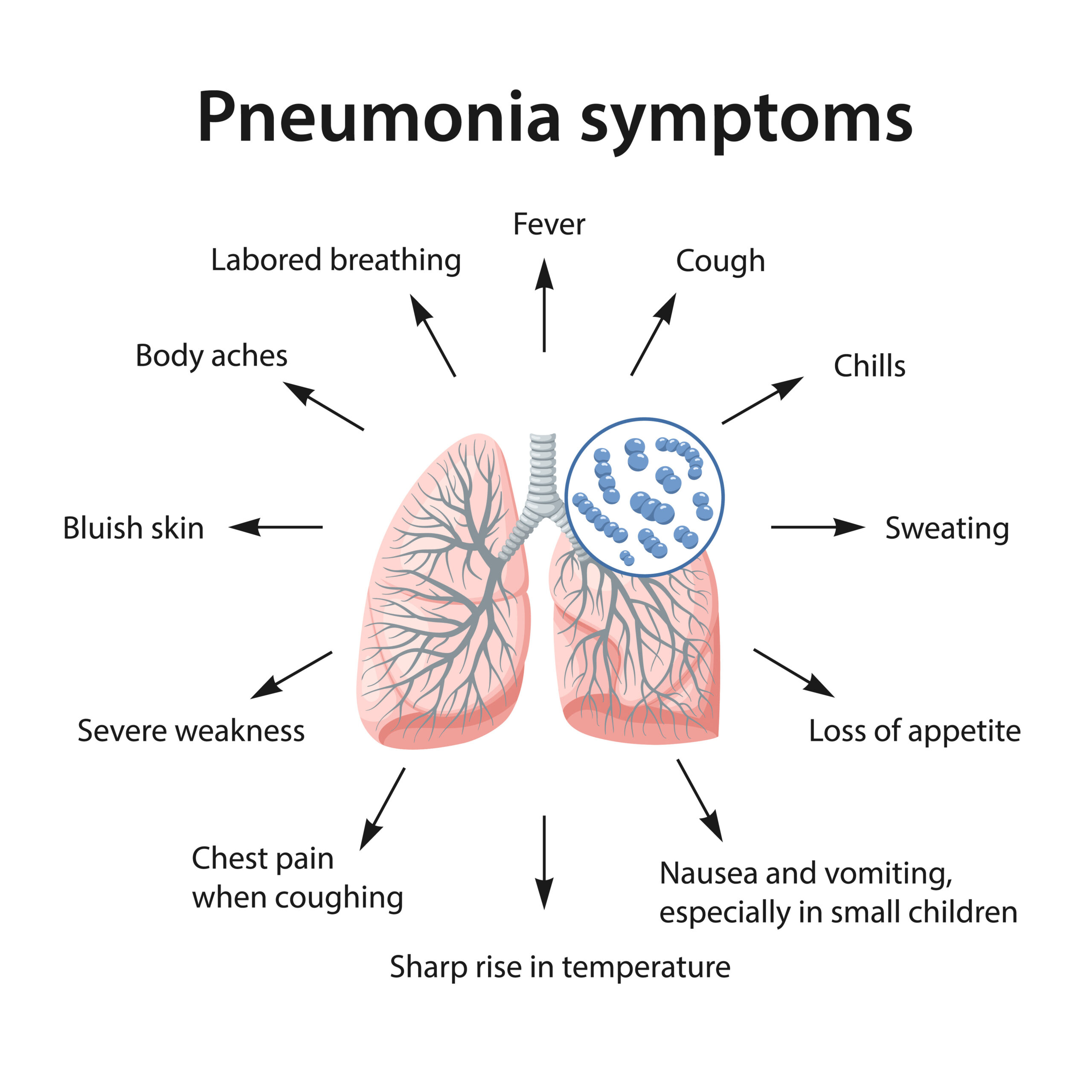 Diagram depicting symptoms of pneumonia.