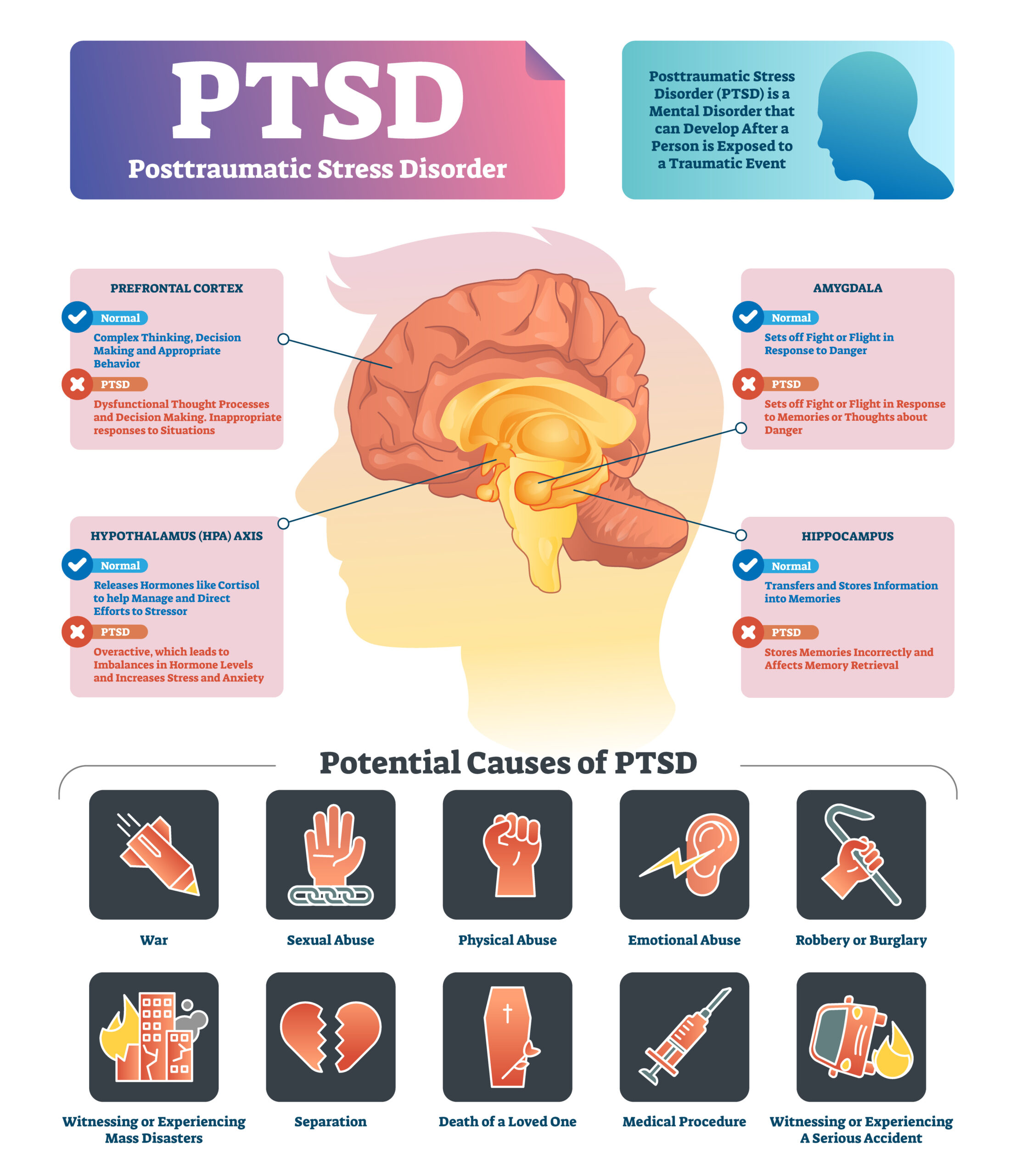 Illustration highlighting different areas of the brain the disease affects as well as potential causes of PTSD.