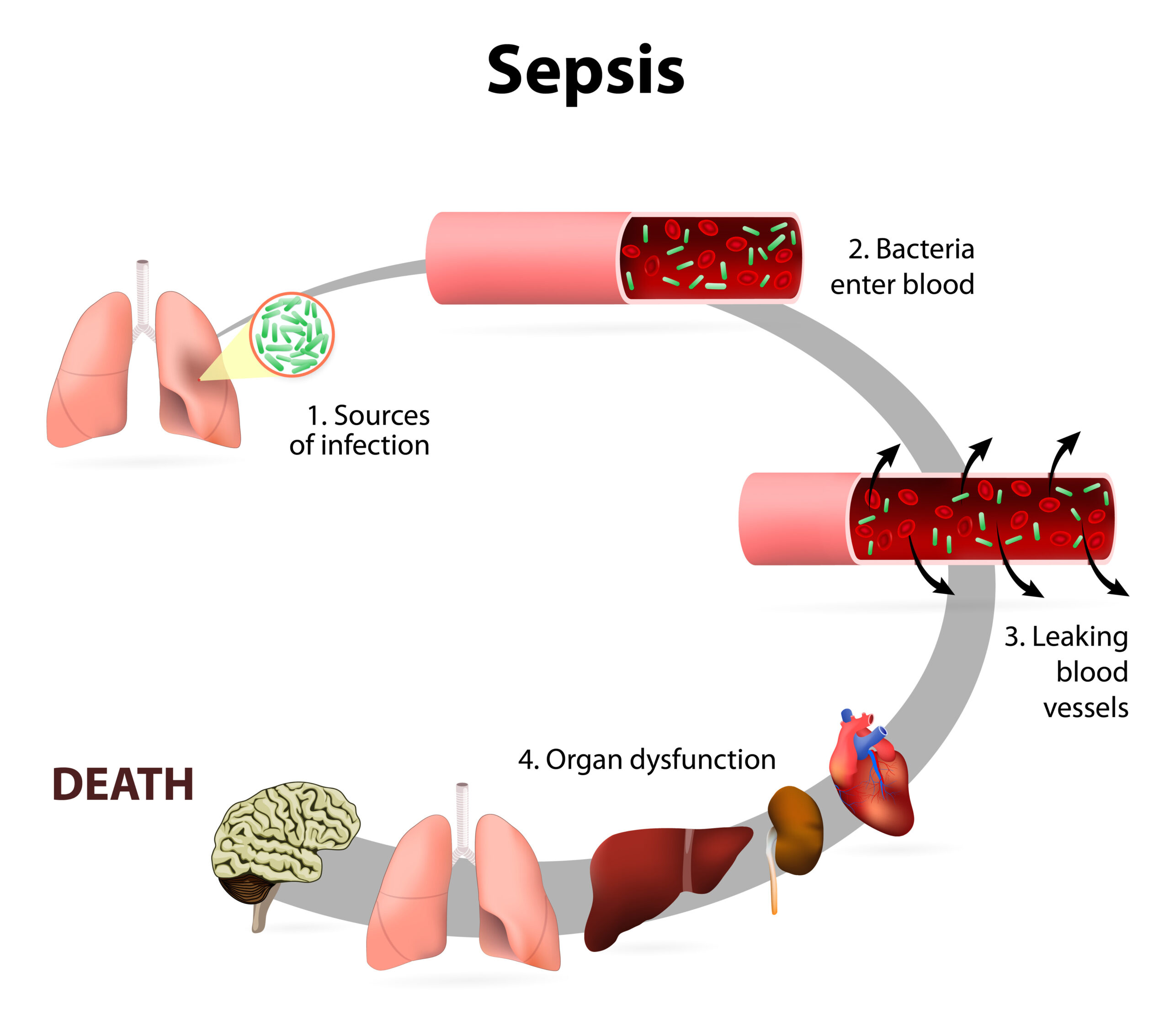 A diagram showing the four lifecycles of sepsis from source of infection to death. 
