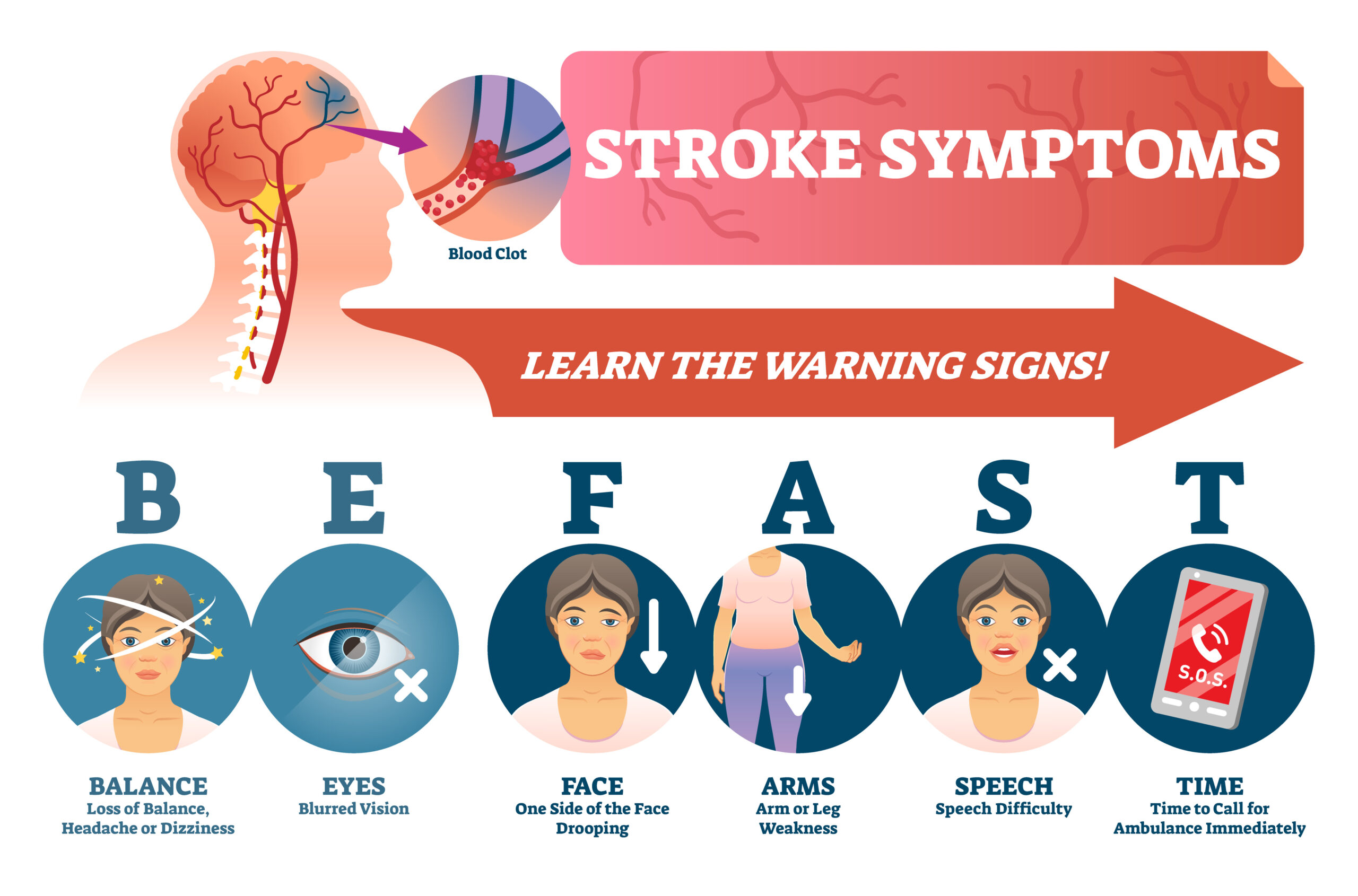 Illustration highlighting BEFAST stroke symptoms